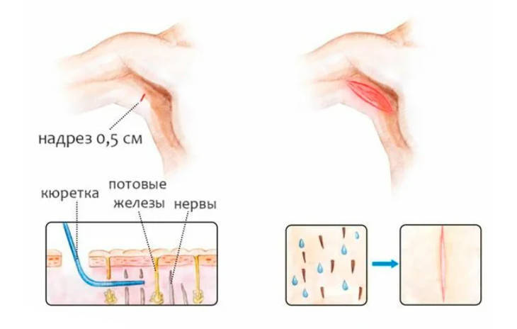 У человека отсутствие потовых желез. Потовые железы в подмышках схема. Потовая железа подмышкой.