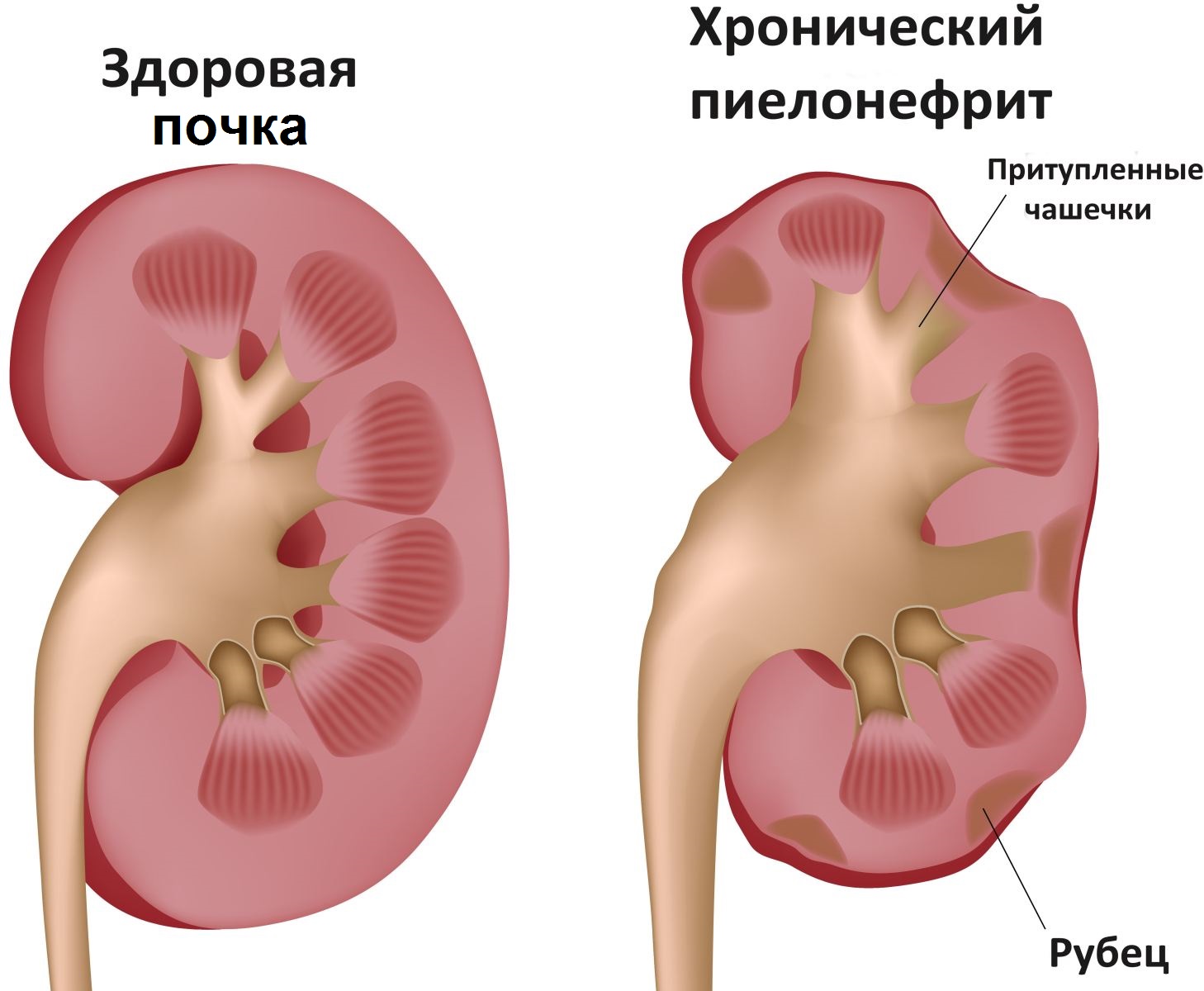 Признаки болезни почек у женщин — симптомы и лечение |СпросиВрача