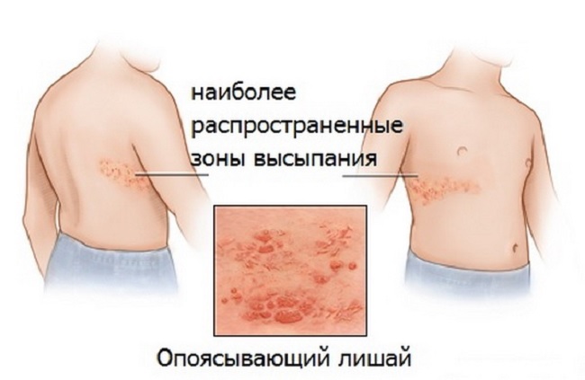 Опоясывающим этот лишай называют из-за его расположения в виде пояса пузырьков Основные причины появления красных пятен на теле: