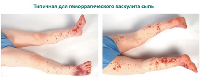 Сыпь может быть симптомом болезней, которые появляются только у детей Почему появляются красные пятна на теле у ребенка: основные причины