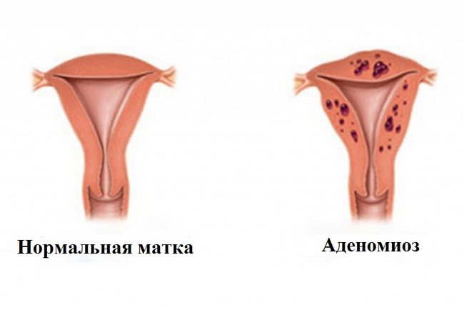 Аденомиоз - это прорастание эндометрия в толщу матки Что значит понятие «аденомиоз»