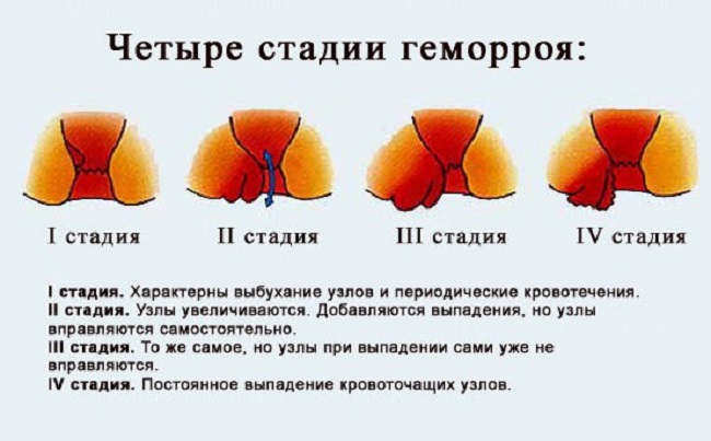 Лечение геморроя необходимо начинать на первой стадии Причины геморроя у женщин