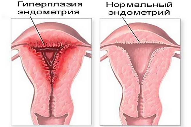 Гиперплазия эндометрия - это разрастание слизистой оболочки матки Описание заболевания