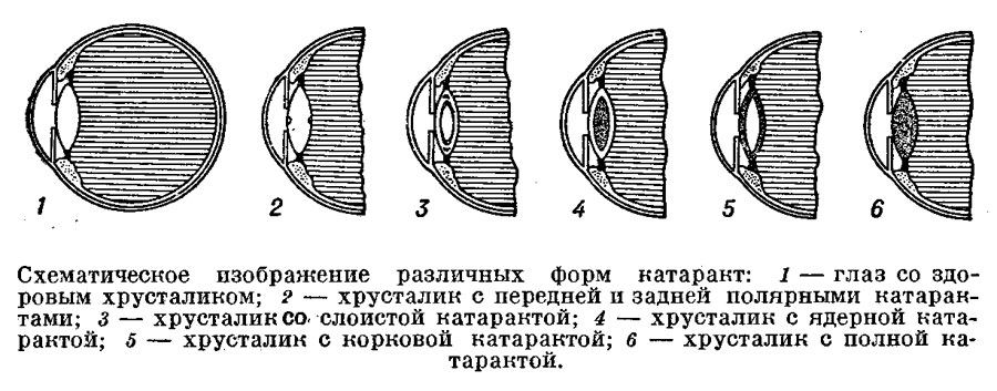 Катаракта: причины, симптомы, лечение и профилактика — СпросиВрача