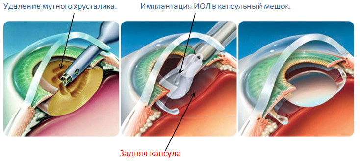 Операция по устранению катаракты предполагает удаление помутневших тканей и введение интраокулярной линзы Лечение