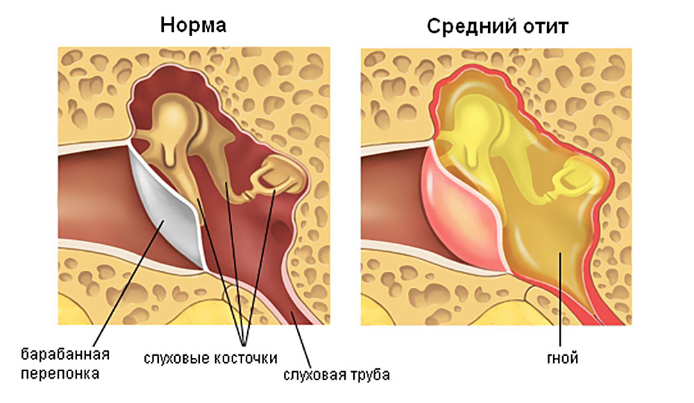 Отит карта смп