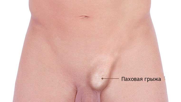 Паховая грыжа - это выпячивание органов брюшной полости Как выглядит грыжа