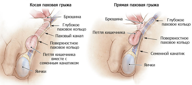 По месту локализации паховая грыжа может быть прямой и косой Виды паховой грыжи у мужчин