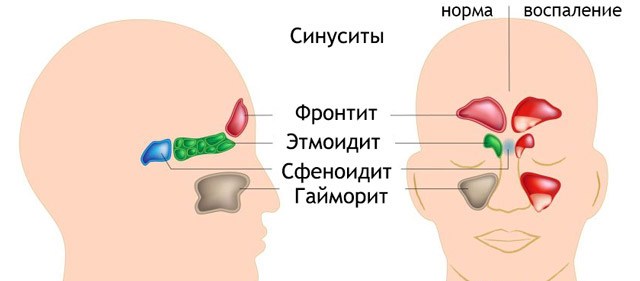 В зависимости от места локализации синусит подразделяется на: гайморит, сфеноидит, фронтит, этмоидит Виды синусита