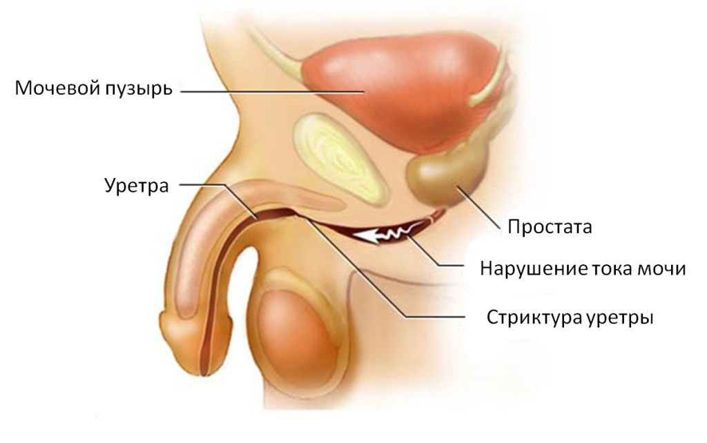 Уретрит - это поражение мочеиспускательного канала в результате инфицирования или травмирования Диета