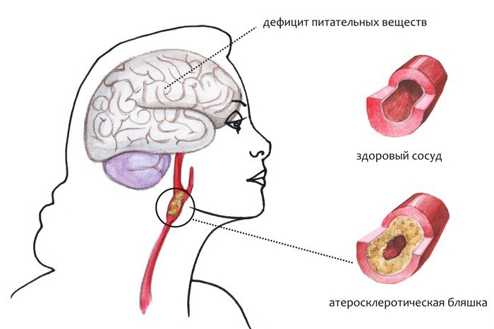 Виды энцефалопатии