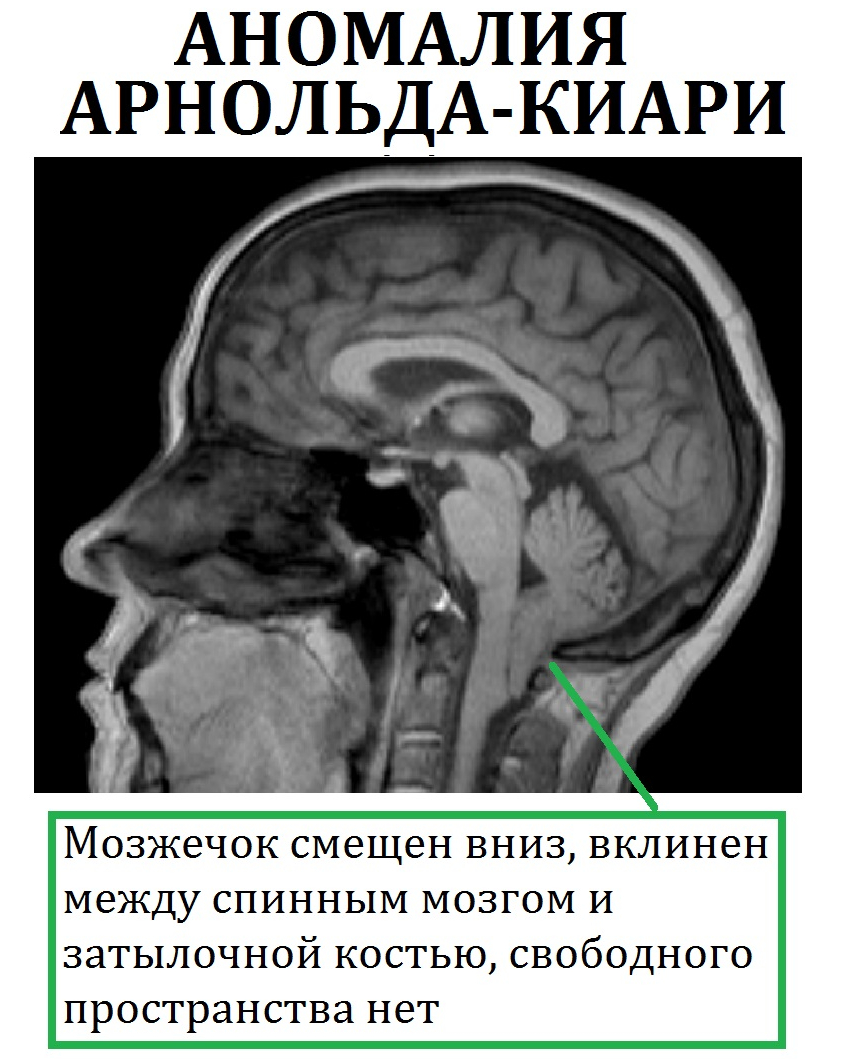Причины гидроцефалии мозга. Врожденная аномалия Арнольда Киари. Аномалия Арнольда-Киари 3. Мальформация Арнольда-Киари 1.