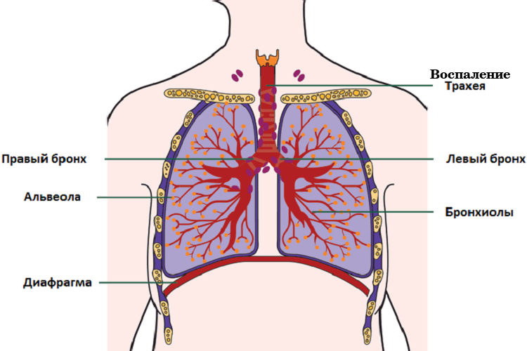Лечение трахеита у детей — симптомы и признаки: как вылечить трахеит у ...