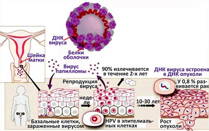 Симптомы рака шейки матки на ранней стадии