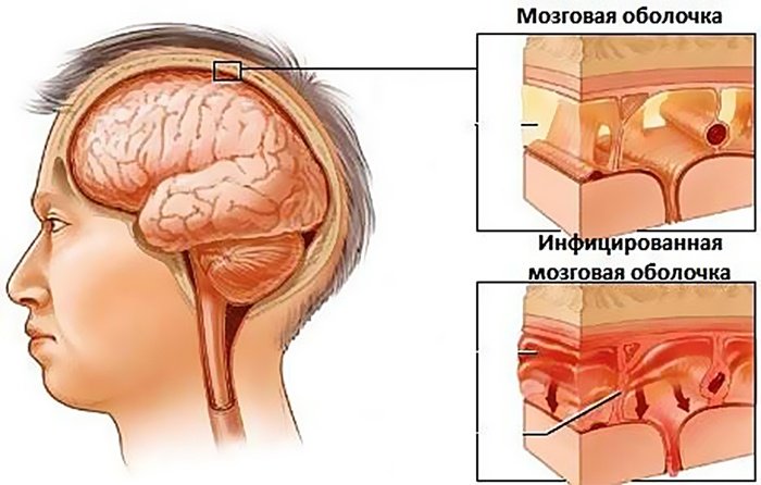 Чем опасен серозный менингит
