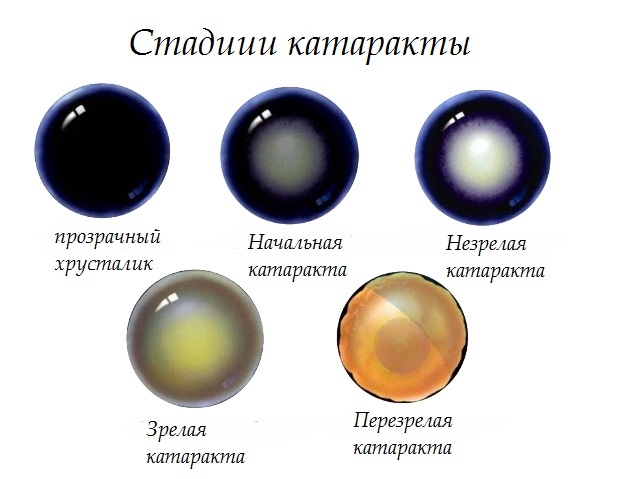 Катаракта: симптомы и лечение, профилактика болезни — СпросиВрача
