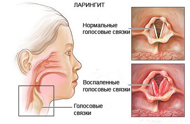 Что вызывает ларингит