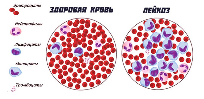 Виды тромбоцитопении