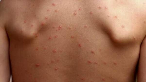 Первые признаки заболевания ВИЧ: симптомы на ранних стадиях