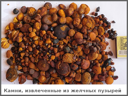 Поражения и желчного пузыря