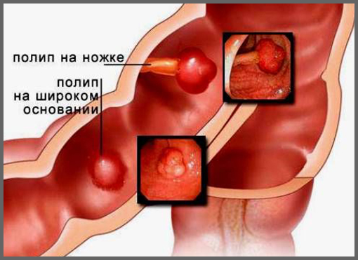 Патологии ЖКТ