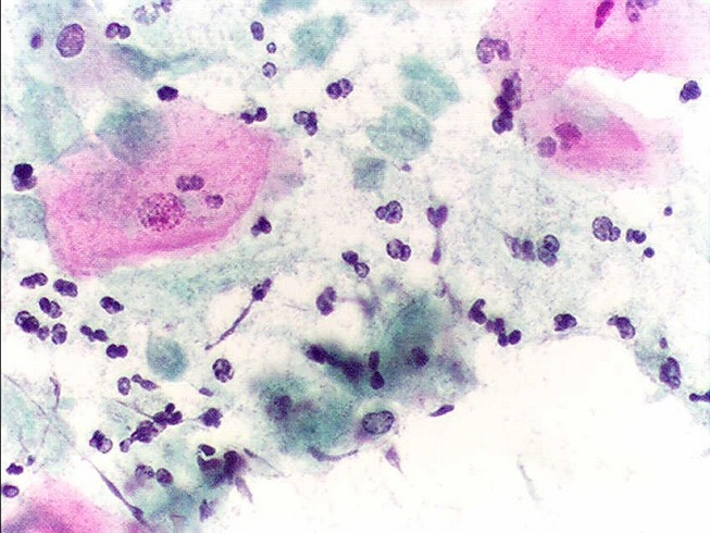 Trichomonas vaginalis - возбудитель трихомониаза Причины заболевания