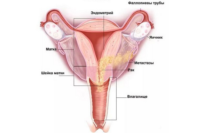 Рак тела матки картинки