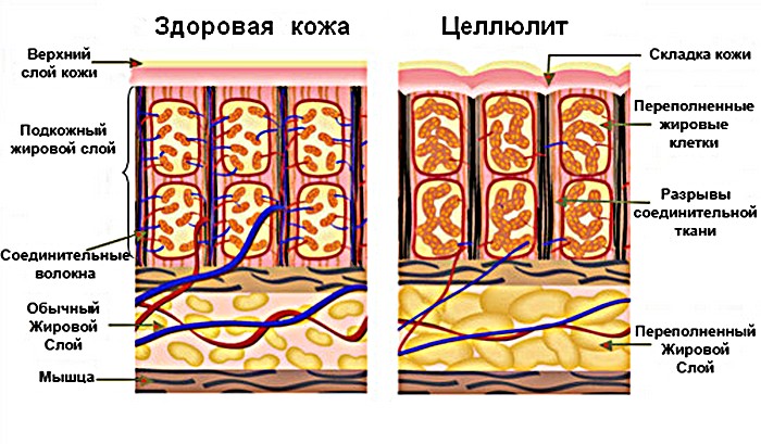 При целлюлите увеличиваются жировые отложения Как появляется целлюлит?